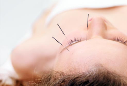 Acupuncture Works Better than Drugs for Headaches